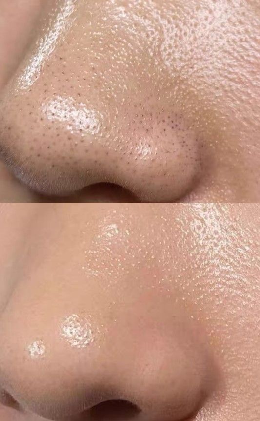 Anti Acne face wash salicylic acid 1%