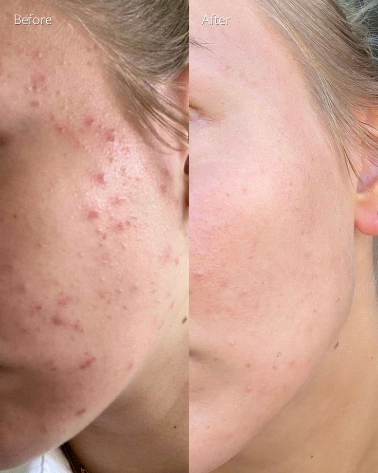 Anti Acne face wash salicylic acid 1%